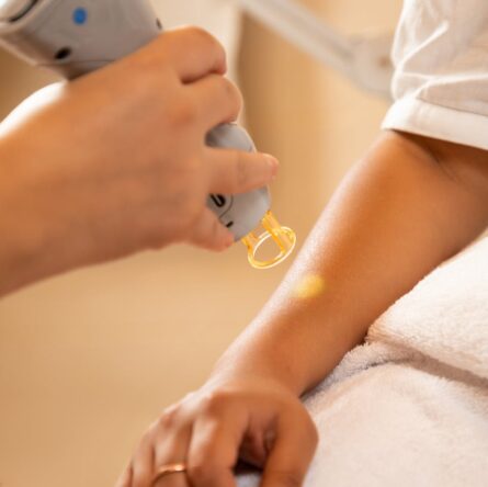 Gros plan d'une séance d'épilation au laser dans un spa, mettant l'accent sur les soins professionnels de la peau et la relaxation.