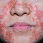 dermatite séborrhéique